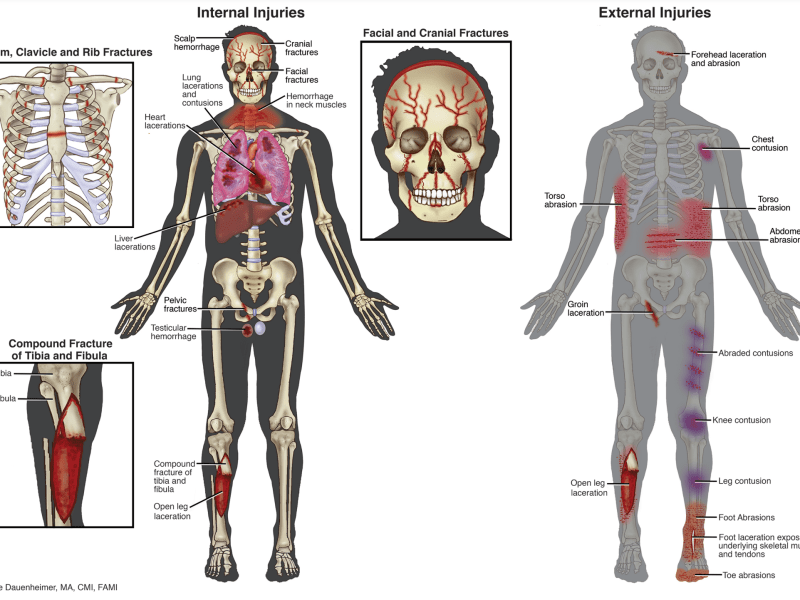 ﻿An illustrated summary of Rey Rivera's injuries